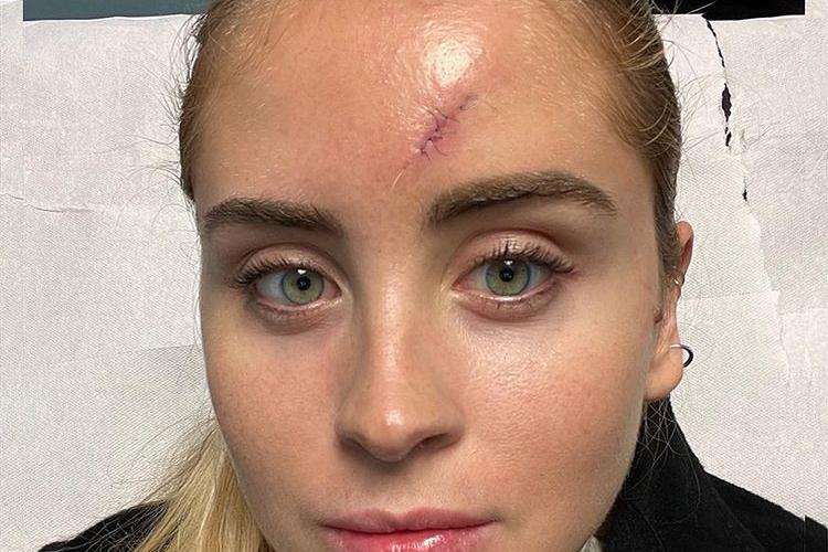 Valentina Ferragni con la vistosa cicatrice (foto da Instagram)