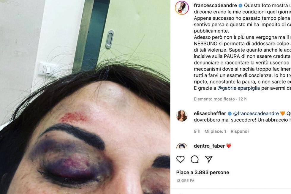 Francesca De Andrè e la foto choc col volto tumefatto: “Il mio ex mi picchiava”