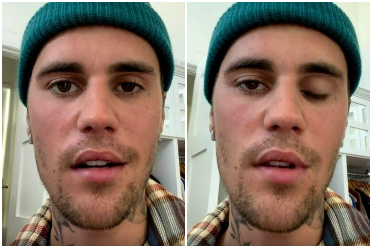 Justin Bieber col volto paralizzato: “Sto male, non posso cantare”