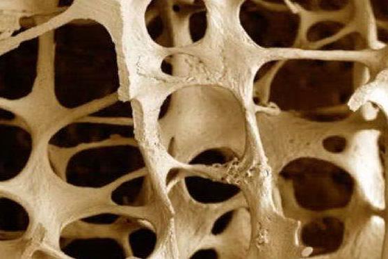 Malattie croniche, la Sardegna ai vertici della classifica nazionale per osteoporosi