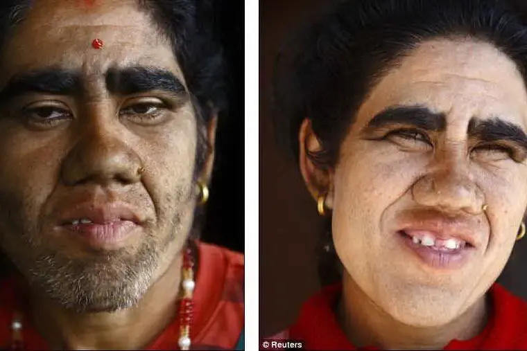 La donna prima e dopo il trattamento.