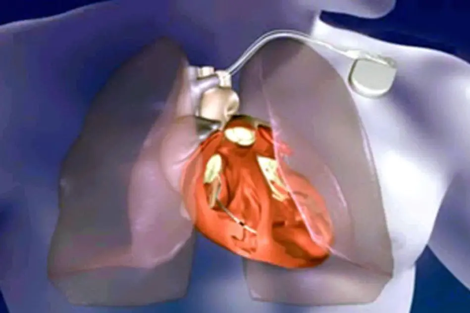 Il defibrillatore cardiaco in grado di segnalare lo scompenso cardiaco (Ansa)