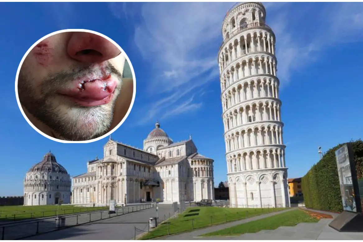 Pisa (Ansa) e le lesioni riportate dal giovane (foto Floris)