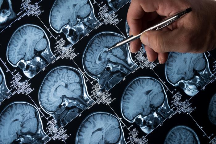 Epilessia, il congresso a Cagliari: focus su sonno, biomarca