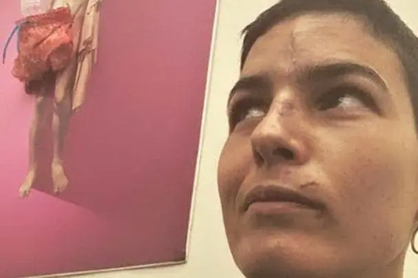 Le cicatrici sul volto di Edelfa Chiara Masciotta (foto Instagram)