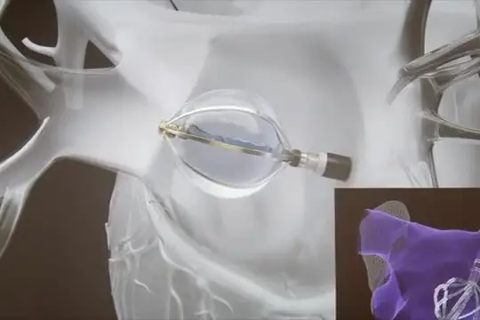 Un "palloncino" per il trattamento della fibrillazione atriale