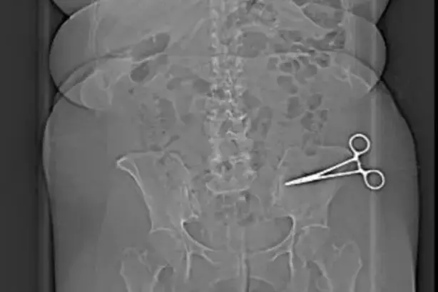 Le forbici dimenticate nell'addome della donna (Foto Ansa)