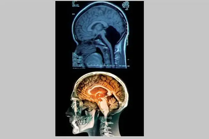 Sopra, la radiografia del cranio della ragazza: la zona nera indica la mancanza di cervelletto (presente nella foto sotto)