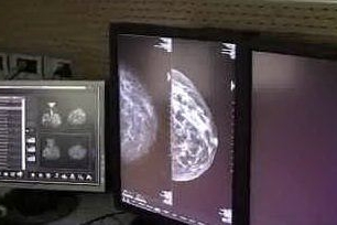 La nuova frontiera della prevenzione: la mammografia in 3D