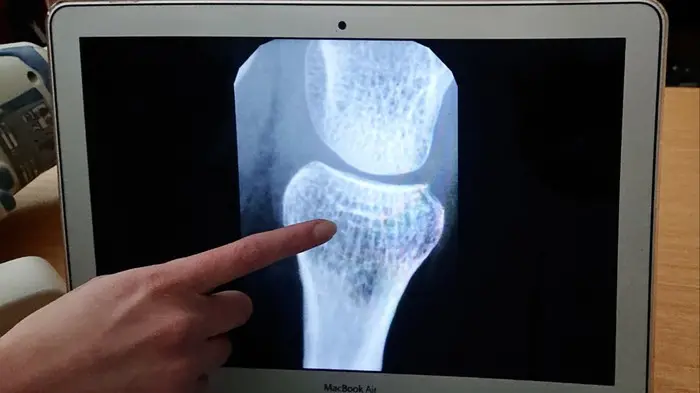 Thin bones, osteoporosis undermines health