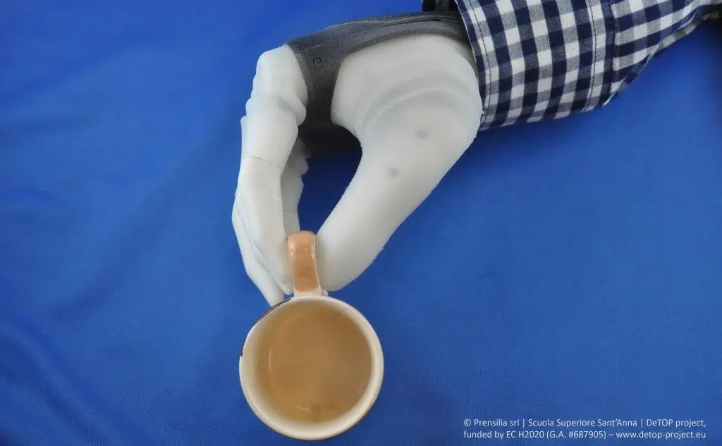 La nuova protesi consentirà alla donna di utilizzare l'arto proprio come prima