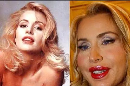 A sinistra Valeria Marini in una foto scattata negli Anni '90, a destra in un'immagine recente: zigomi e labbra sono stati ritoccati dal chirurgo