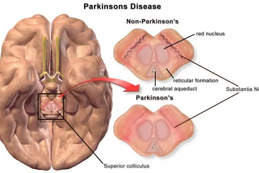 La malattia di Parkinson (foto da wikimedia)