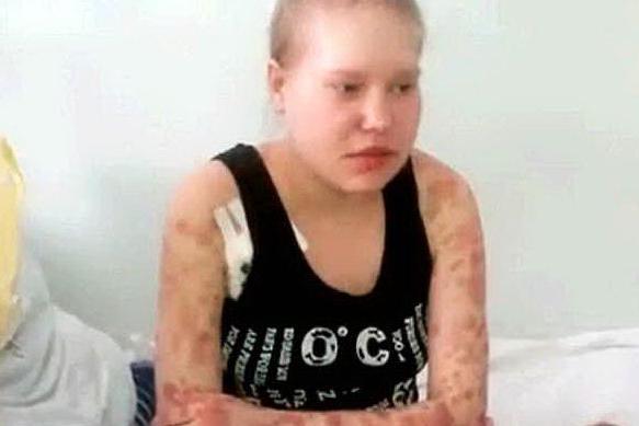 Una ragazza siberiana vittima della droga Krokodil