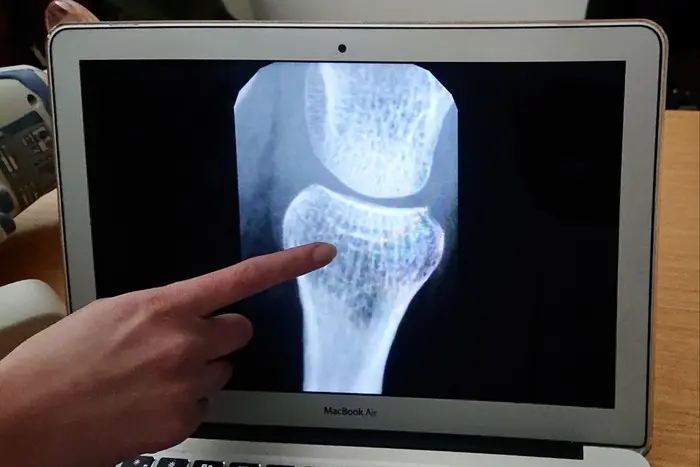 Osteoporosi (immagine simbolo, foto Ansa)