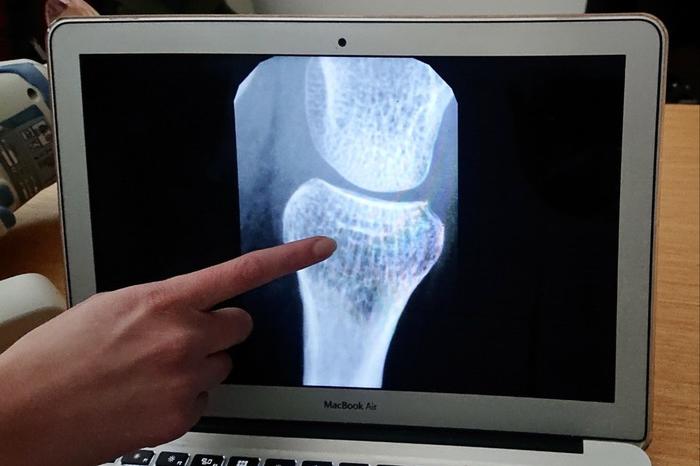 Osteoporosi: ossa fragili, attenzione alle fratture (foto Ansa)