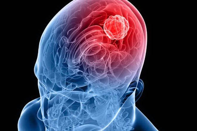 Una rete per &quot;catturare&quot; il tumore del cervello: efficace contro il glioblastoma multiforme