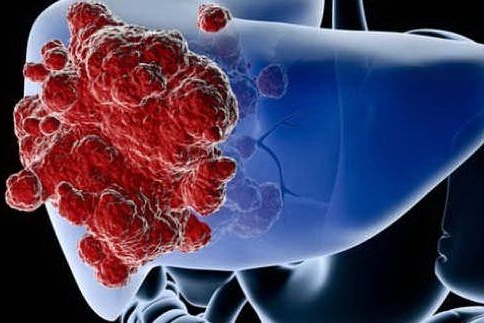 Prg-4, la proteina che aiuta la terapia contro il cancro al fegato