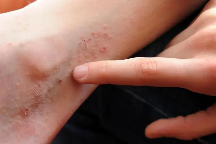 Dermatite atopica (foto Ansa)