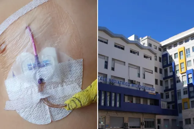 Il catetere venoso su un bambino e, a destra, il Microcitemico