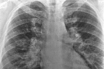 Sarcoidosi in una radiografia (foto da google)