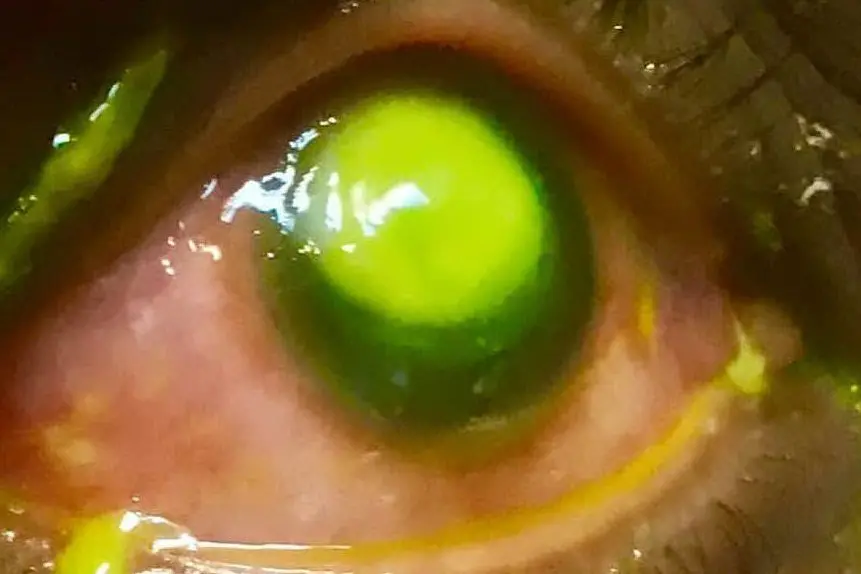 L'infezione del paziente (foto Vita Eye Clinic)