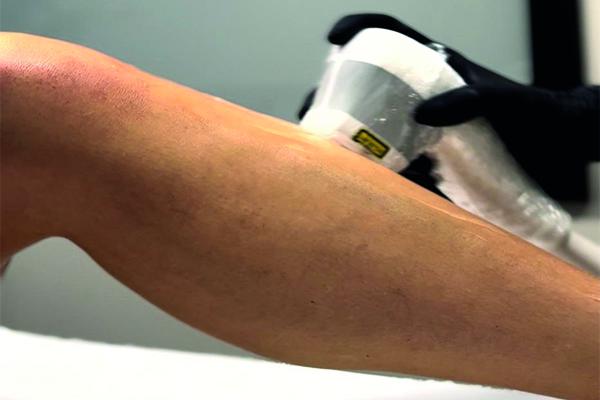 Addio peli superflui: perché la primavera è il momento d’oro per l’epilazione laser