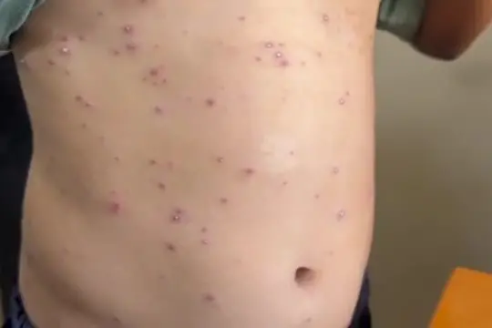 Epidemia di varicella a Gaza: "Impossibile isolarsi"