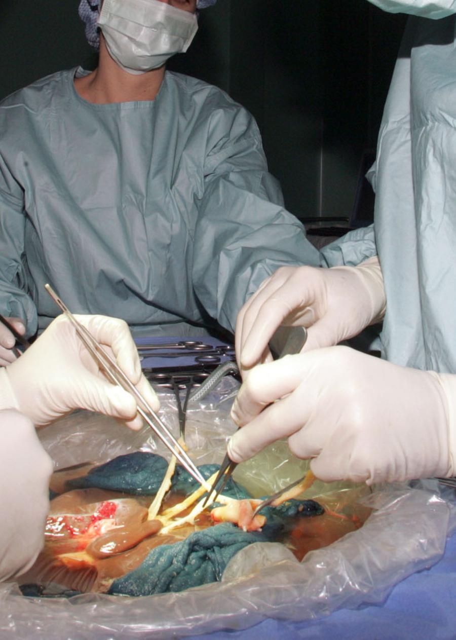 Peggiora il bimbo trapiantato, restano poche ore