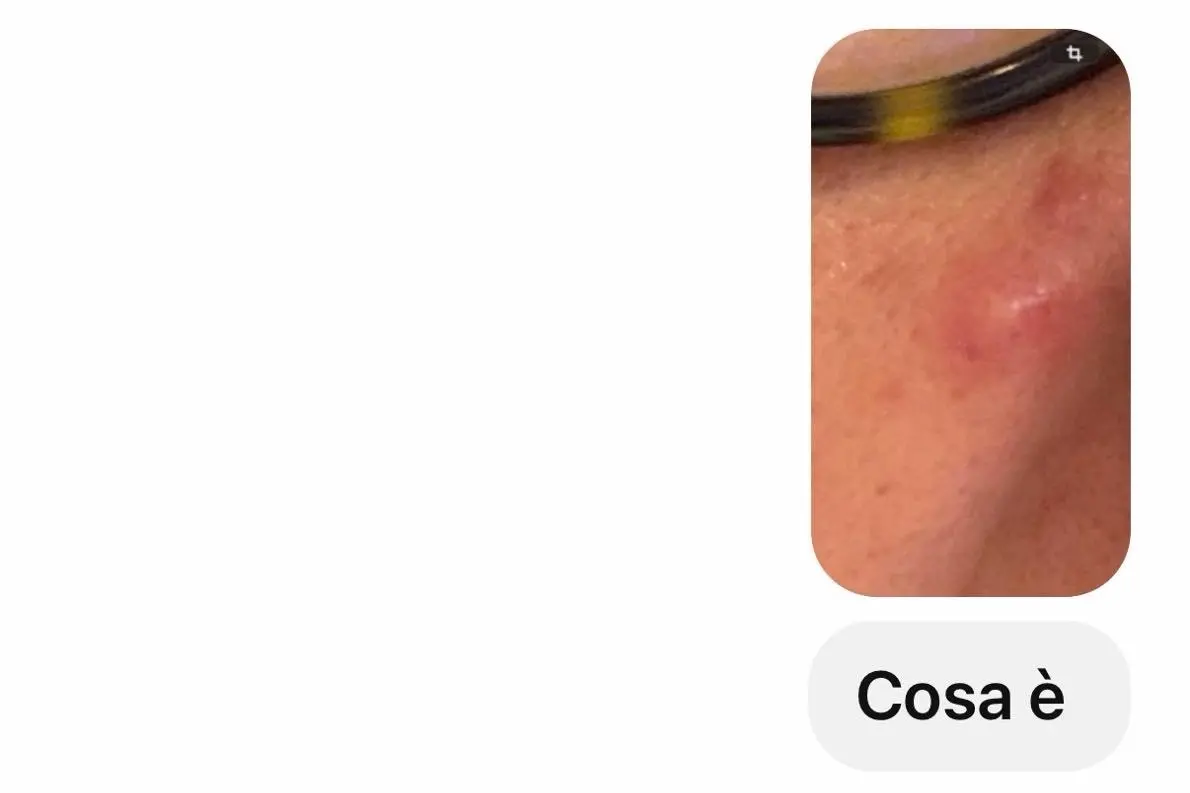 La richiesta a ChatGpt di una cagliaritana su una macchia sulla pelle