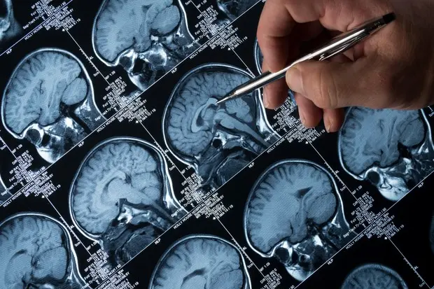 Alzheimer, nuove speranze di cura da uno studio (foto Ansa)